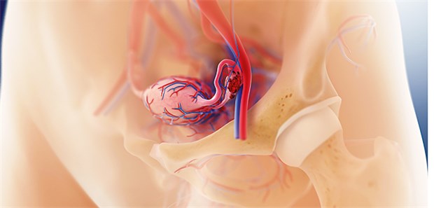 Betablocker verbessern wohl beim Ovarialkarzinom die immunologische Mikroumgebung.