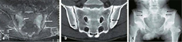 Bilaterale Veränderungen in den Sakroiliakalgelenken bei Spondylitis ankylosans. Im CT zu erkennen: chronisch strukturelle Veränderungen mit Sklerosierung, Erosionen (Pfeile). © Springer Medizin