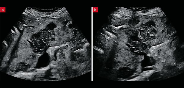 Bild 1: B-Bild-Sonografie; ausgedehnte echoarme zentrale Leberläsion (10×4 cm) mit mehreren echoarmen Satelliten