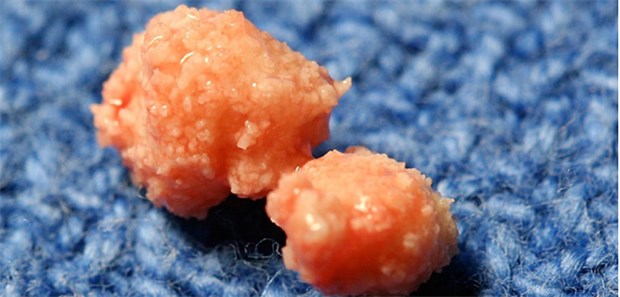 Akute Pankreatitis: Idiopathisch ist die Ausnahme