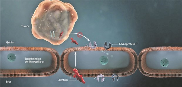 Alectinib greift auch Hirnmetastasen beim fortgeschrittenen NSCLC an