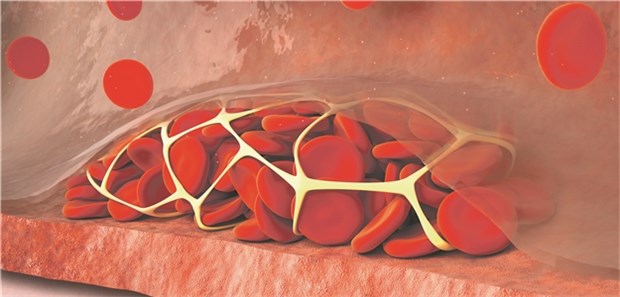 Thrombophlebitis – Alles andere als harmlos! Thrombophlebitis – Alles andere als harmlos!