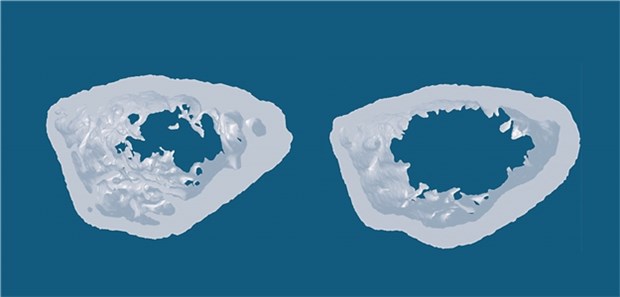 Osteoporose – neue Teile im großen Krankheits-Puzzle Osteoporose – neue Teile im großen Krankheits-Puzzle