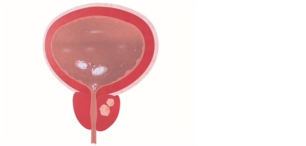 MRT-basierte Biopsie schlägt Standardbiopsie