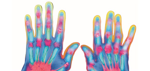 Rheuma "brennt nicht aus"!