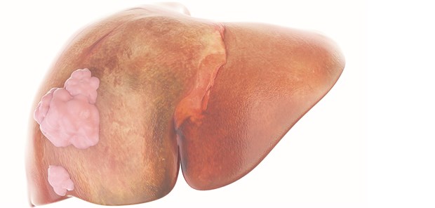 Auch bei Leberkrebs-Spätrezidiv Chance auf kurative Therapie