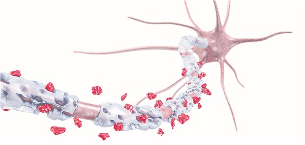 Neurofilament zeigt Therapieerfolg bei MS an