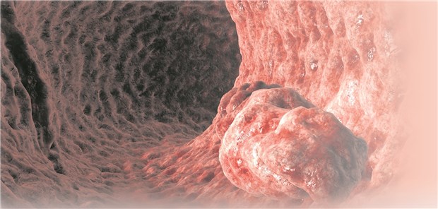 Schub für die Darmkrebsvorsorge?