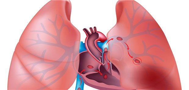 Auch ein NOAK erlaubt frühe Entlassung nach Lungenembolie