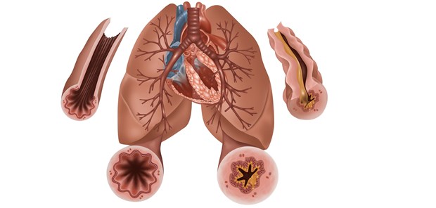 Mit Mikroben gegen Asthma