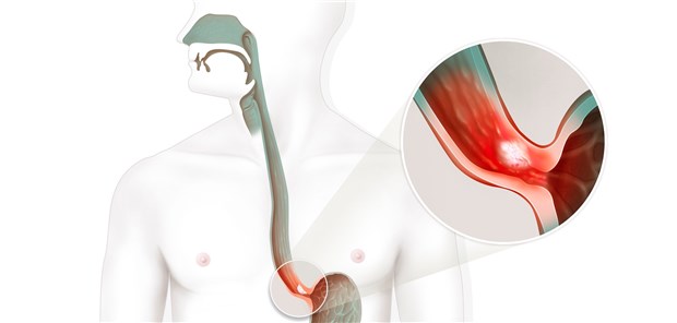 Wie oft zur Kontroll-Endoskopie?