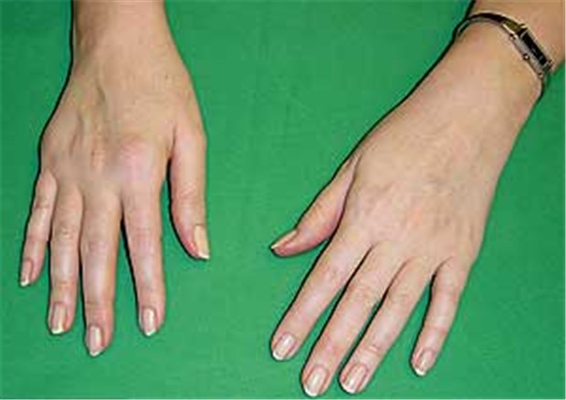 Manchmal genügt bei Rheuma eine Methotrexat-Therapie Manchmal genügt bei Rheuma eine Methotrexat-Therapie