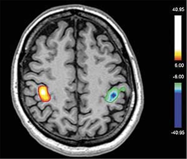 Bildgebung erhellt den Effekt von Antipsychotika Bildgebung erhellt den Effekt von Antipsychotika