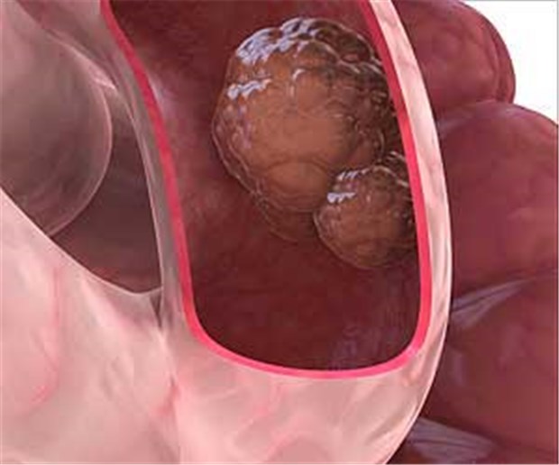 Gesucht wird: Substanz, die sich zur Chemoprävention von Darmkrebs eignet Gesucht wird: Substanz, die sich zur Chemoprävention von Darmkrebs eignet