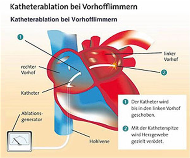 Jeder Zweite nach Katheterablation beschwerdefrei Jeder Zweite nach Katheterablation beschwerdefrei
