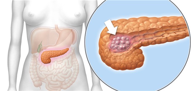 Screening ist weiterhin keine Option