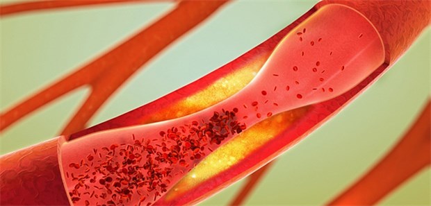 Mit PCSK9-Hemmer bilden sich Koronar-Plaques zurück