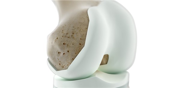 Welche Prothese ist von Vorteil?