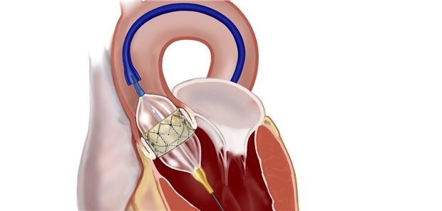 Klappen-Op und TAVI auf lange Sicht ebenbürtig Klappen-Op und TAVI auf lange Sicht ebenbürtig