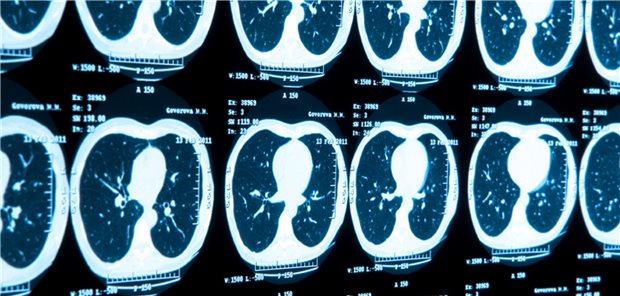Krebserkrankung mit der höchsten Mortalität: das Lungenkarzinom
