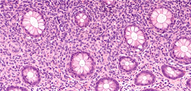Wettlauf gegen die Zeit: Chancen beim aggressiven DLBCL