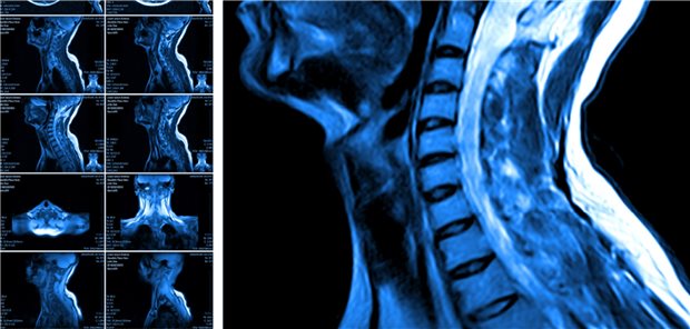 Kopf-Hals-Tumoren: Immunonkologische Ansätze in der Praxis