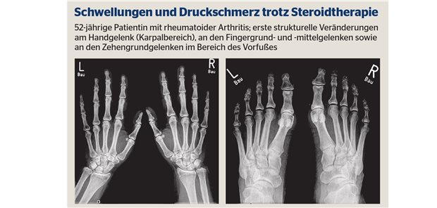 Rheumatoide Arthritis: effektive Therapie mit Filgotinib