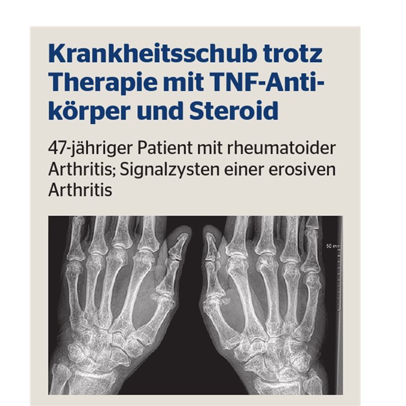 Rheumatoide Arthritis effektive Therapie mit Filgotinib
