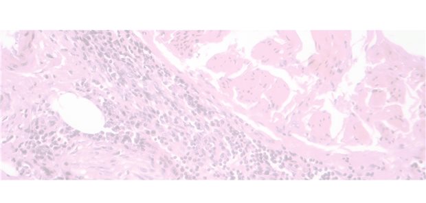 Avelumab-Erstlinien-Erhaltungstherapie im Behandlungsalltag