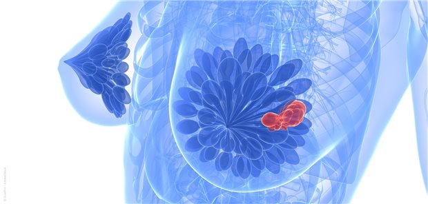 Palbociclib als Therapieoption in der Erstlinie