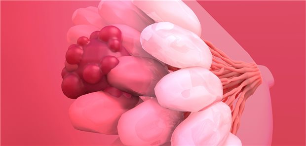 Expertenstimmen zur CDK4/6-Inhibition beim HR+/HER2- Mammakarzinom