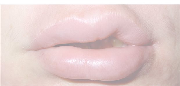 Bis zur Diagnose gehen oft viele Jahre verloren