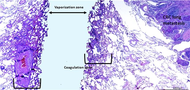 Die Risiken und Nebenwirkungen der Laserresektion bei Filiae