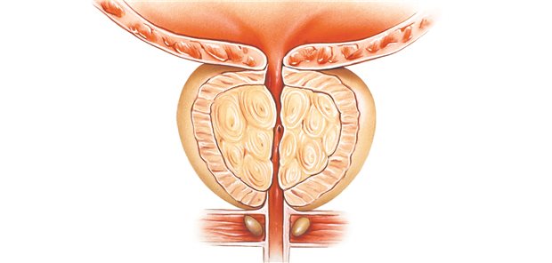 Therapie der benignen Prostatahyperplasie: Wie häufig Strikturen sind