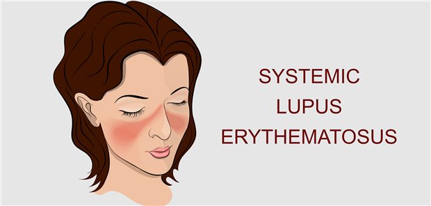Junge Leute mit Zoster? – bei Lupus keine Seltenheit Junge Leute mit Zoster? – bei Lupus keine Seltenheit