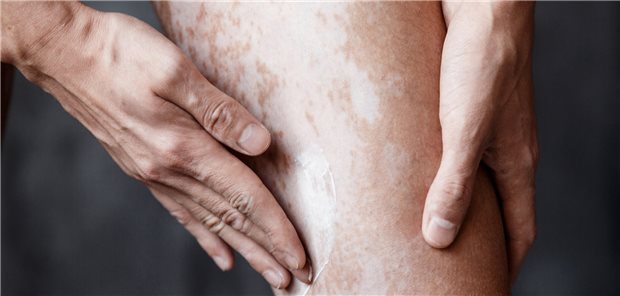 Vitiligo - eine chronische Autoimmunerkrankung mit hoher psychosozialer Krankheitslast