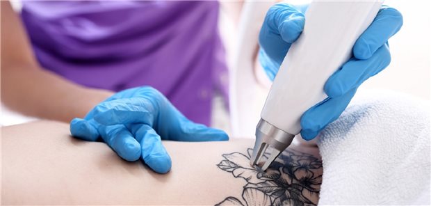 Tattooentfernung
