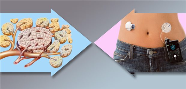 Inselzelltransplantation versus Closed-Loop mit Insulinpumpe und kontinuierlicher Glukosemessung