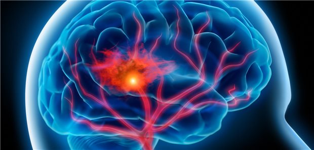 Antikoagulation nach Hirnblutung: Mehr Nutzen als Schaden