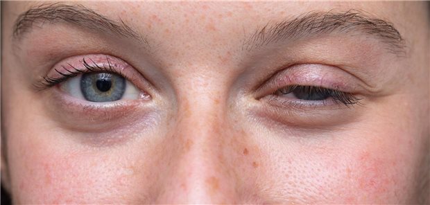 Erster Erfolg mit CAR-T-Zelltherapie gegen Myasthenia gravis