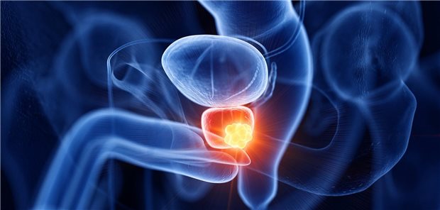Radioligandentherapie des mCRPC erhält laut Studie Lebensqualität