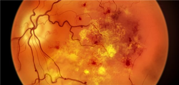 Latenter Autoimmundiabetes: Diabetische Retinopathie häufiger als bei Typ-2-Diabetes