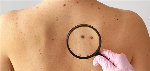 Merkelzellkarzinom: Erste Daten zu Nivolumab in der Adjuvanz lassen hoffen