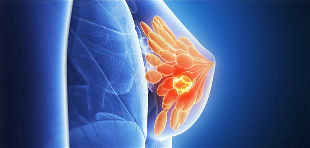 Vorteile für deeskalierte Chemotherapie bei frühem Brustkrebs