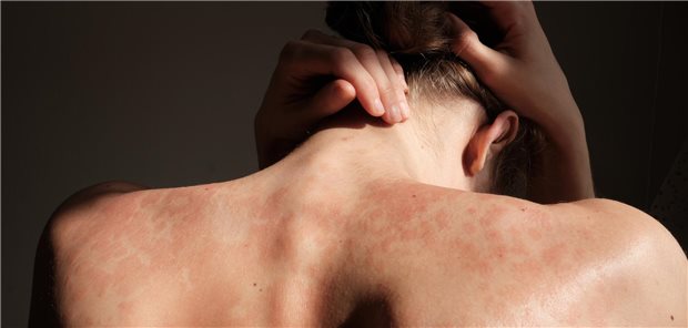 Psoriasis: Wohl geringeres Krebsrisiko unter Interleukin-Inhibitoren