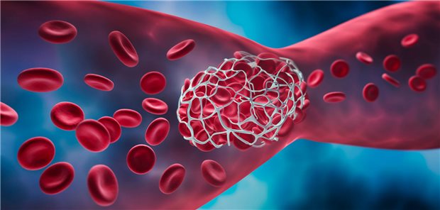 Thrombolie-Prophylaxe lohnte sich bei Krebskranken mit hohem Risiko