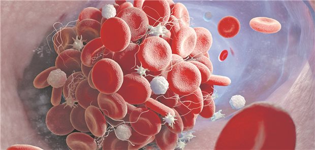 Noch einmal: Keine DOAK bei Antiphospholipidsyndrom!