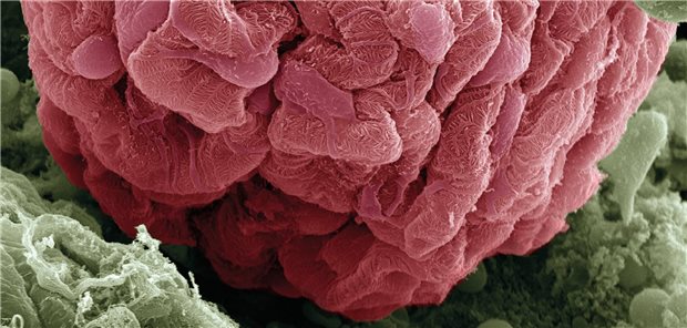 Komplement-3-Glomerulopathie (C3G): rechtzeitig erkennen, besser versorgen