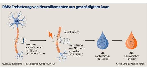 Aktivitätsmarker in der Therapie der aktiven, schubförmigen MS