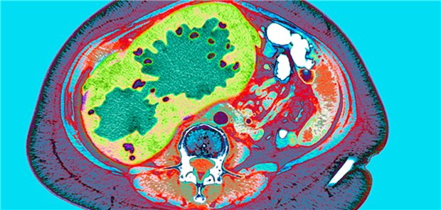 Die aktuelle Therapielandschaft beim HCC